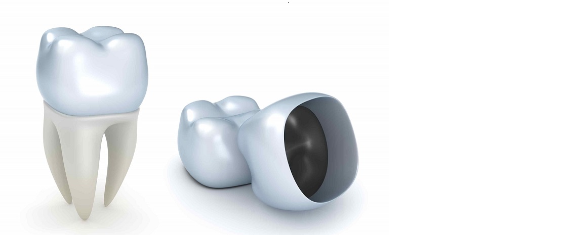 Affordable Cheap Good Dentist Dental Crown in Box Hill Melbourne ,Burwood ,Surrey Hills, Camberwell,Blackburn ,Mount Waverley Glenwaverley Forest hill Vermont Nunawading1