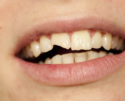 Affordable Cheap Teeth Tooth Bonding cost Dentist in Box hill south Melbourne mount albert burwood blackburn camberwell doncaster glen waverley mount waverley ashwood deakin University forest hill